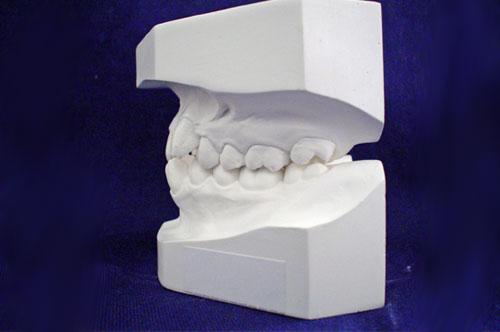 Dental Bridge