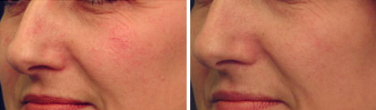 V-Beam Laser Vein Removal Before & After