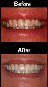 Before and After Veneers