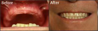 Before / After Dental Implants