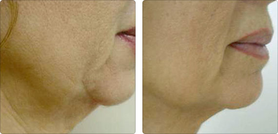 Skin Tightening - Cheek