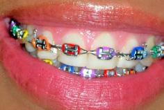 Colored Braces