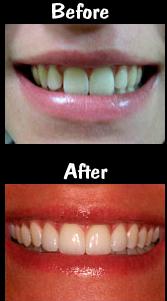 Before and After Veneers