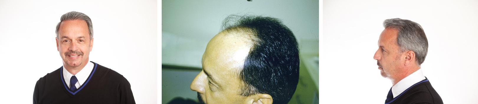 Before & After Treatment of Alopecia (Male Pattern Baldness)