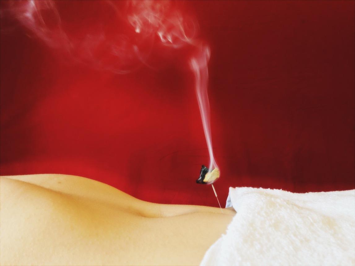 Woo Shin Acupuncture - Federal Way - Moxibustion