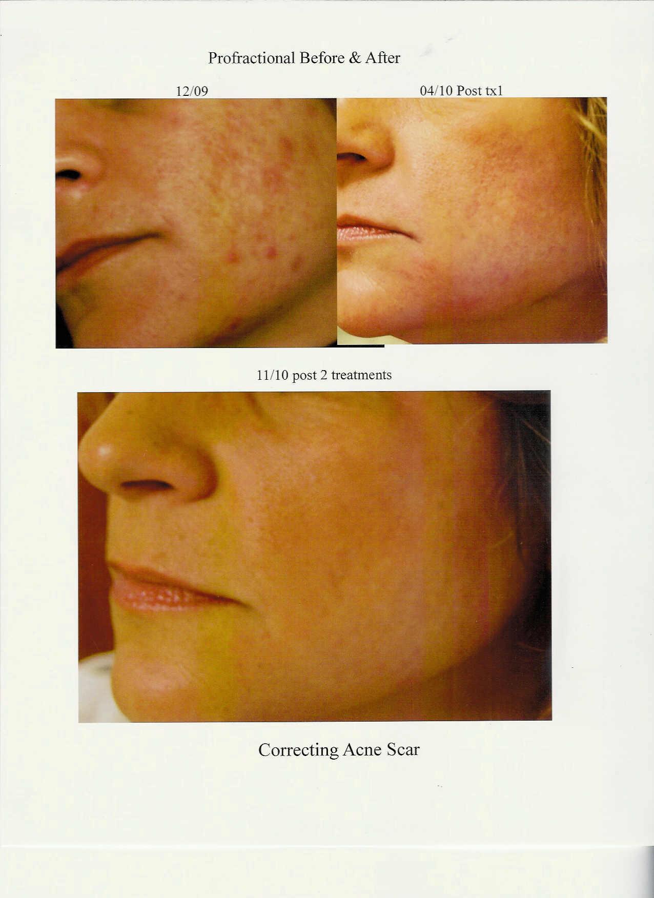 Profractional for acne scars, discoloration or severe wrinkles.