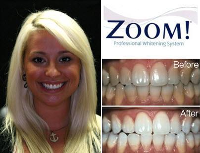 Teeth Whitening by Zoom