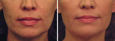 Laser Skin Tightening Before & After at Blue Water Spa