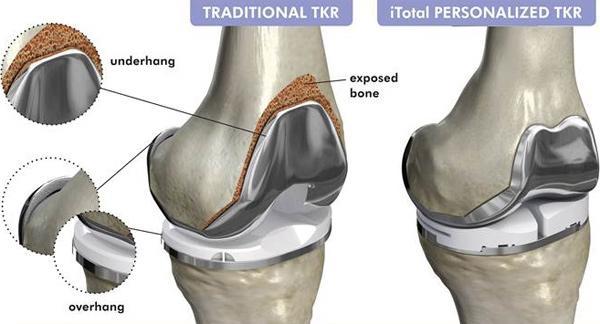 Patient Specific Custom Knee Replacement