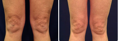 Laser Skin Tightening Before & After at Blue Water Spa