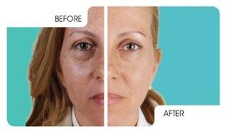 Before and After Nonsurgical Facelift