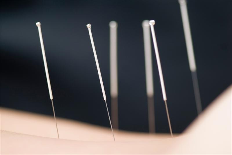 Acupuncture