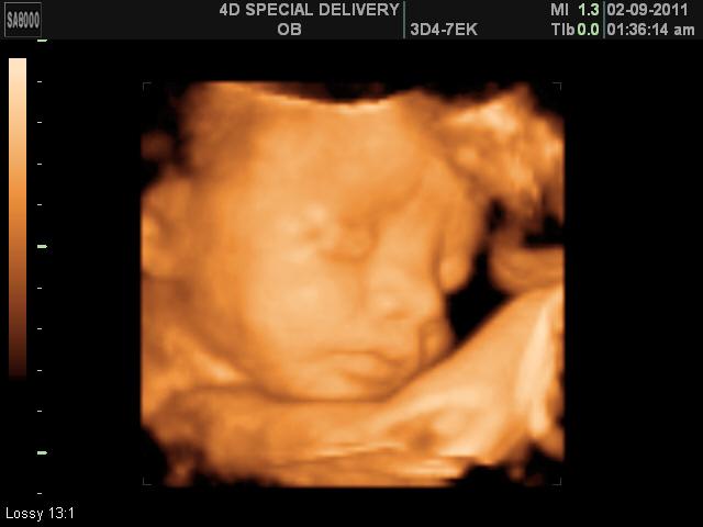 3D 4D Ultrasound by 4D Special Delivery