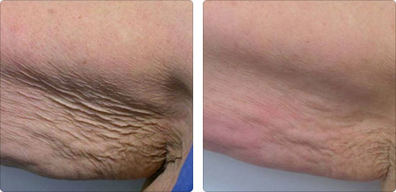 Skin Tightening - Arms