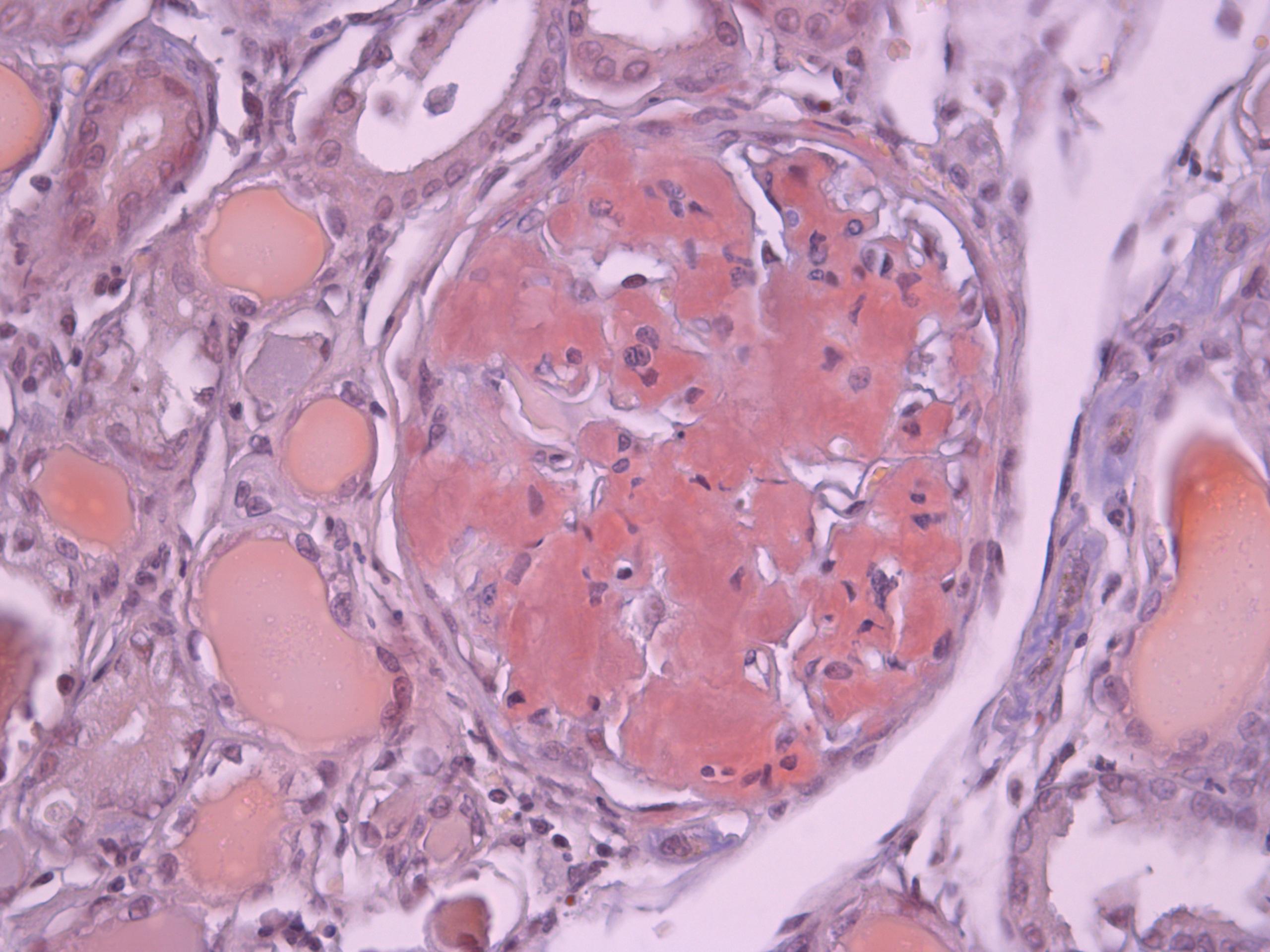 Amyloid Kidney