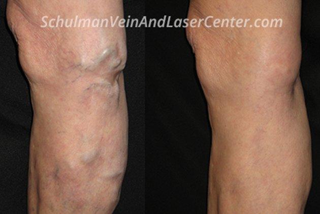 Schulman Vein and Laser Center