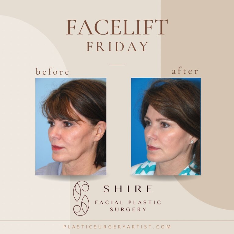 Shire Facial Plastic Surgery