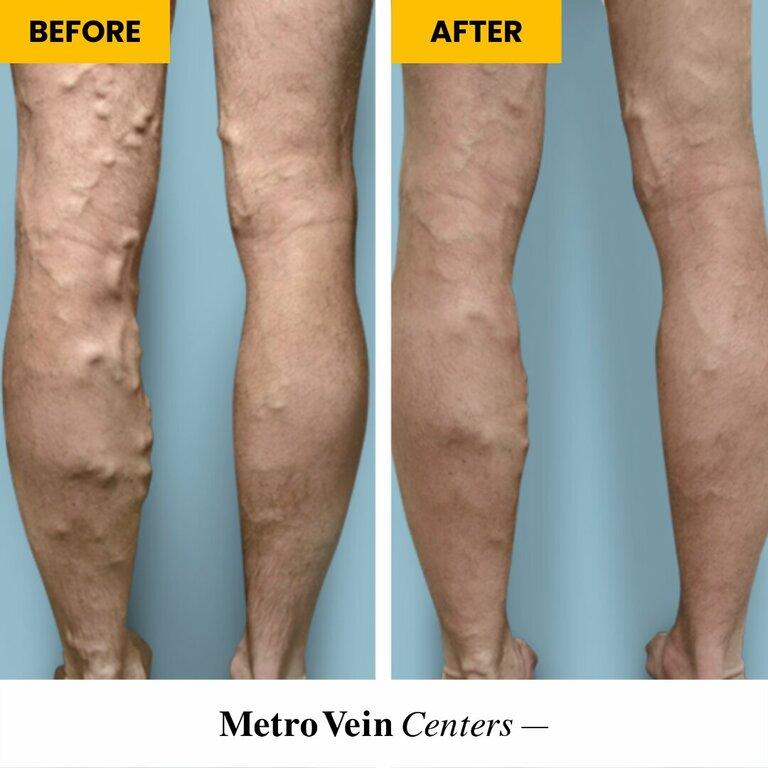 Metro Vein Centers | Manhattan, Midtown