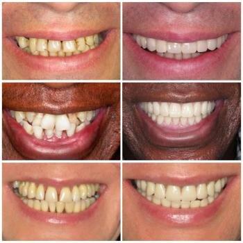 All on Four Dental Implants New Jersey