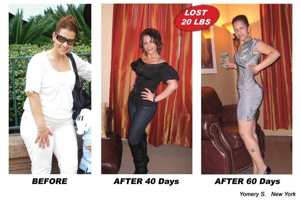 Endermologie Weight Loss Center in La