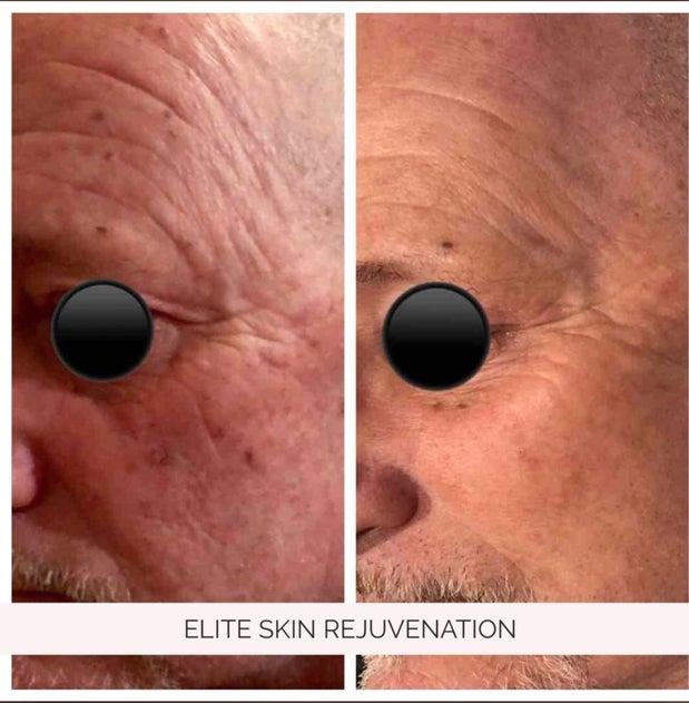 Elite Skin Rejuvenation