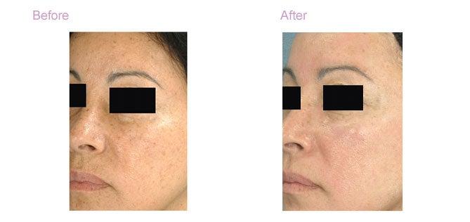 Ageless Beauty Laser