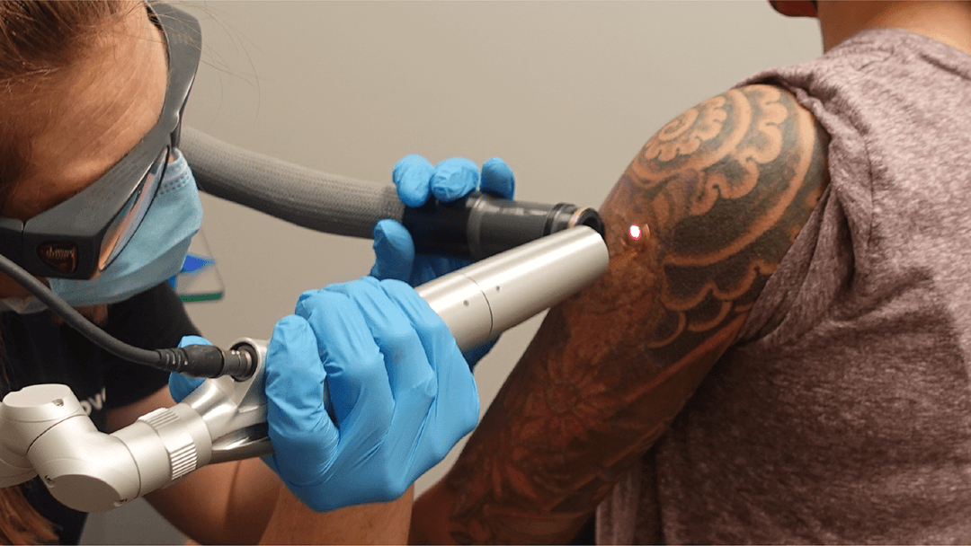 Removery Tattoo Removal & Fading