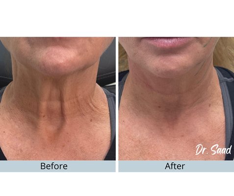 PDO thread neck skin tightening.