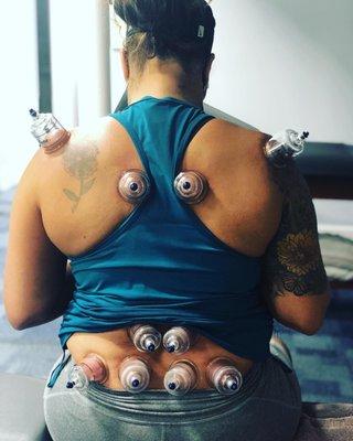 Some cupping to help improve soft tissue mobility thus improving larger pain free active range of motion (AROM).