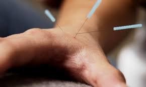 Community Acupuncture just $30.