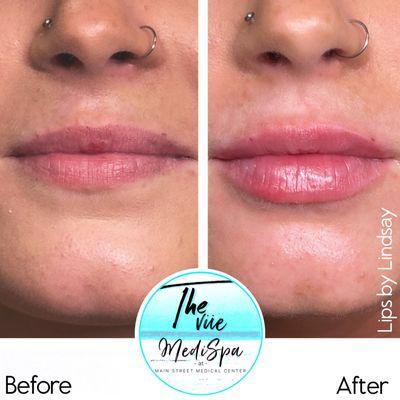 Lip Filler