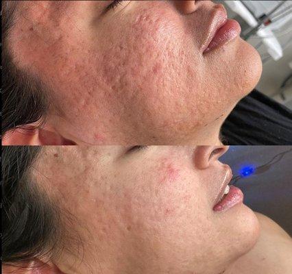 Microneedling Before/After