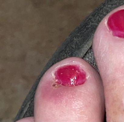 My poorly painted, infected toe.