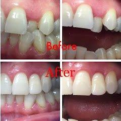 Before and After at NÜVA Smile | Clifton, NJ