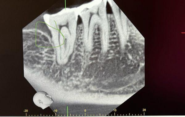 Bone/gum structure surrounding my tooth before treatment