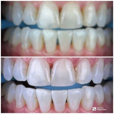 First Glance Teeth Whitening