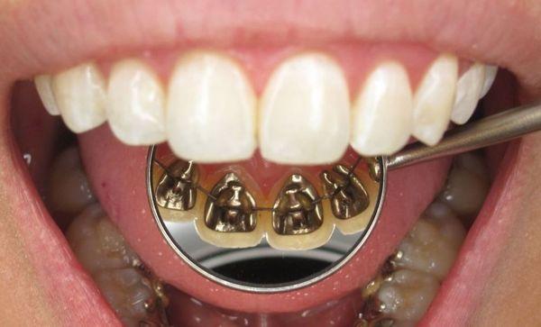 Lingual braces are placed behind the teeth, rather than in front, and therefore offer a great cosmetic alternative to traditional braces.