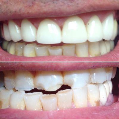 Full upper all-porcelain veneers and crowns.