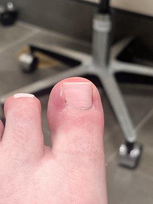 Infection from pedicure