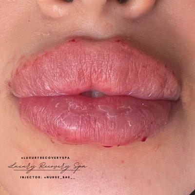 Lip filler