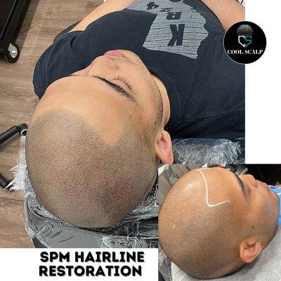 Complete Hairline restoration