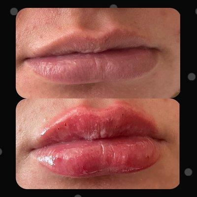 Lip filler before and after