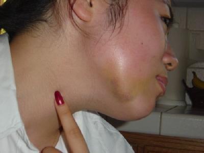 Bruise on my jaw, post extraction. Gruesome, no? I bruise really easily.