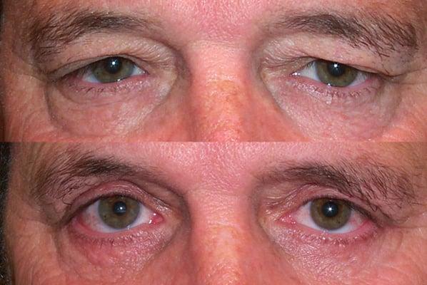 Upper and Lower Blepharoplasty
 www.DrMarkBrown.com 
 Mobile, AL 36609
 251-650-5437