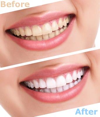 Cosmetic Dentistry available - Tooth Whitening, Veneers, Crowns/Bridges, Tooth Colored Fillings and Invisalign (clear braces)