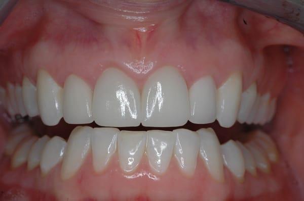 Two central incisors restored to proper function with beautiful esthetics. ( dentistry performed by Dr. Sullivan )