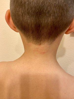 Scratches from the clippers all over my son's neck.