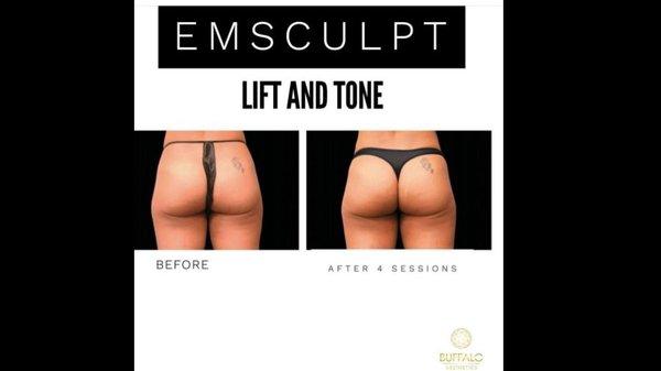 Emsculpt Buttock lift and Tightening