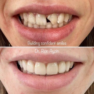 Accidents happen! 4 veneers fixed this patient's smile