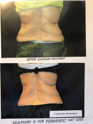 Before and After photo of SculpSure Treatment (actual client of Eze Health Center)